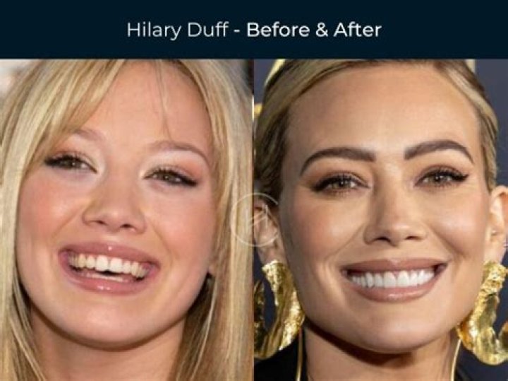 Does Hilary Duff Have Veneers?
