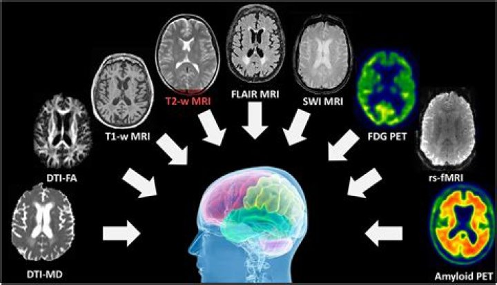Glioblastoma: 5 Things To Know About The Brain Cancer John McCain Was Diagnosed With