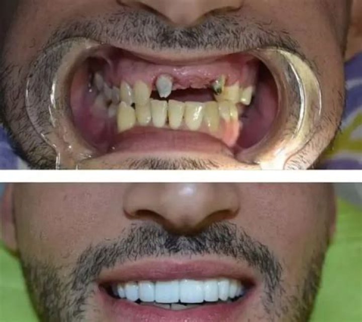 Sam Asghari’s Teeth: Before Implanting New Ones!
